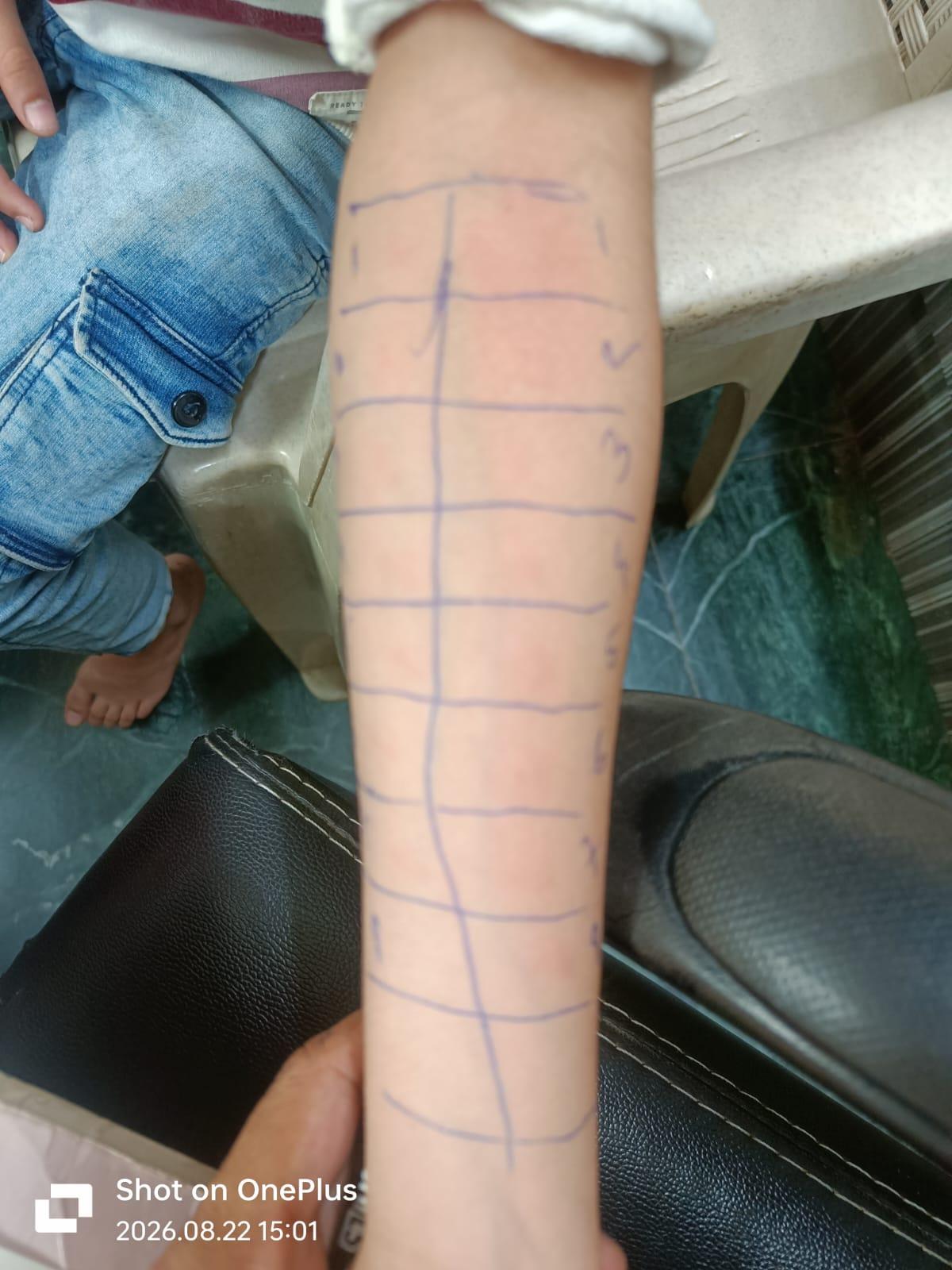 Skin prick test